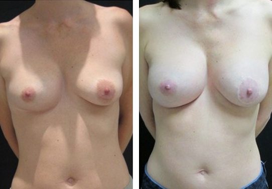 9555-Front-breast-implant-exchange - Breast Implant Exchange - Before And After - Fairfax and Manassas VA