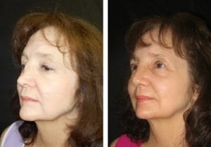 9810-side-rhinoplasty-for-women - Rhinoplasty For Women - Before And After | Fairfax and Manassas VA