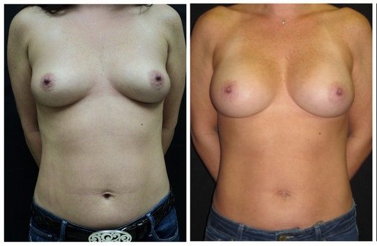 9820a-breast-augmentation - Breast Augmentation Before And After - Fairfax and Manassas VA