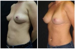 9820b-breast-augmentation - Breast Augmentation Before And After - Fairfax and Manassas VA