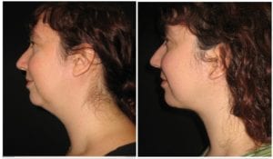 9873c-necklift - Neck Lift - Before And After | Fairfax and Manassas VA