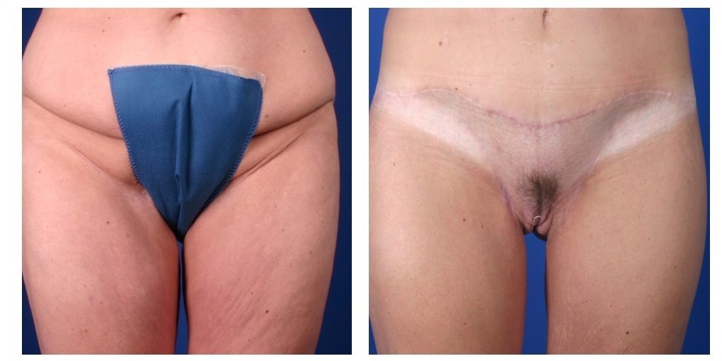 C1a-after-weight-loss - Body Contouring After Weight Loss - Before And After - Fairfax & Manassas VA