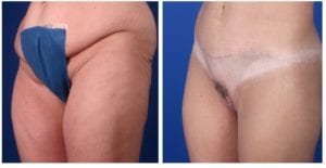 C1b-after-weight-loss - Body Contouring After Weight Loss - Before And After - Fairfax & Manassas VA