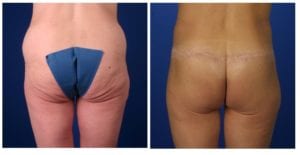 C1c-after-weight-loss - Body Contouring After Weight Loss - Before And After - Fairfax & Manassas VA