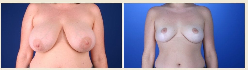 CX12-breast-reduction - Breast Reduction Before And After - Fairfax and Manassas VA