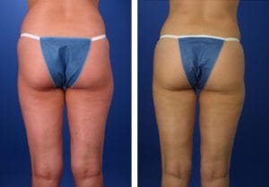 CX17-liposuction - Liposuction - Before And After - Fairfax and Manassas VA