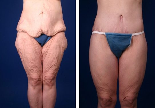 CX19-thigh-lifts - Thigh Lifts Before And After - Fairfax and Manassas VA
