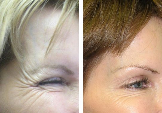 Crows-Feet-Botox-Patient-16-botox - Botox - Before And After | Fairfax and Manassas VA