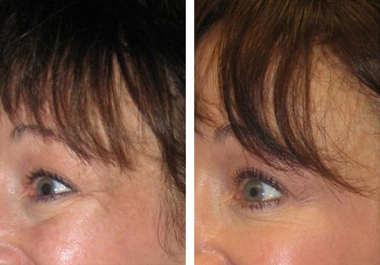 Crows-feet-Botox-patient-4-botox - Botox - Before And After | Fairfax and Manassas VA