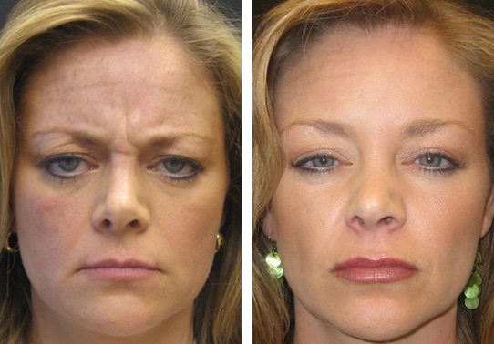 Frown-Line-Botox-Patient-16-botox - Botox - Before And After | Fairfax and Manassas VA