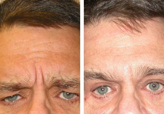 Frown-Line-Botox-Patient-6-botox - Botox - Before And After | Fairfax and Manassas VA