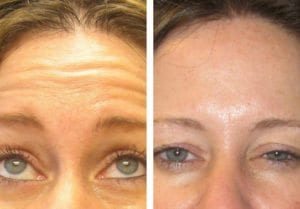 Botox - Before And After | Fairfax and Manassas VA