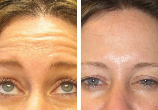Frown-Line-Botox-Patient-7-botox - Botox - Before And After | Fairfax and Manassas VA