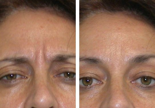 Frown-line-Botox-Patient-3-botox - Botox - Before And After | Fairfax and Manassas VA