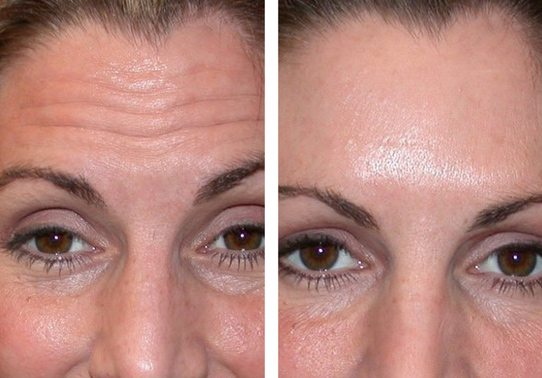 Frown-line-Botox-Patient-8-botox - Botox - Before And After | Fairfax and Manassas VA