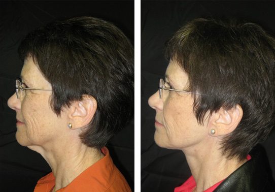 Mini-facelift-collage-mini-facelift - Mini Facelift - Before And After | Fairfax and Manassas VA