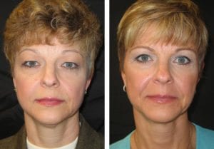 Lower Eyelid Lift - Before And After - Fairfax and Manassas VA