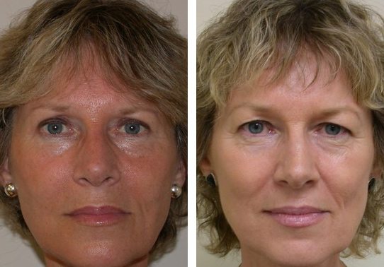 Patient-0009-eyelid-lifts-lower - Lower Eyelid Lift - Before And After - Fairfax and Manassas VA