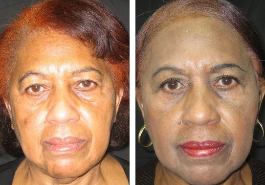 Patient-001-eyelid-lift-upper-and-lower - Upper and Lower Eyelid Lift - Before And After - Fairfax and Manassas VA