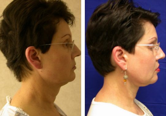 Patient-001527011b82eb64-necklift - Neck Lift - Before And After | Fairfax and Manassas VA