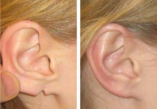 Patient-0015270149ad5fd9-torn-earlobe-repair - Torn Earlobe Repair - Before And After | Fairfax and Manassas VA