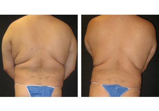 Patient-0015271095d4c346-liposuction - Liposuction - Before And After - Fairfax and Manassas VA