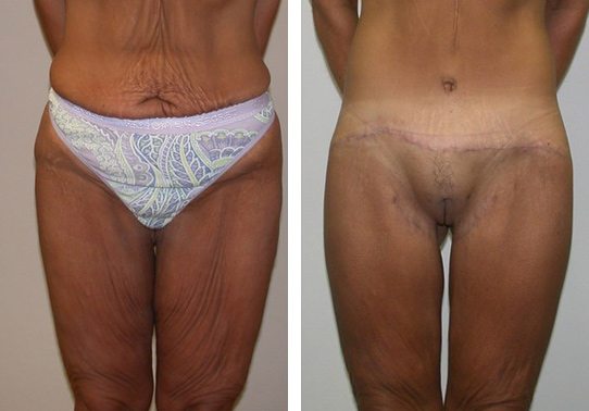 Patient-00152710dcf3fac8-thigh-lifts - Thigh Lifts Before And After - Fairfax and Manassas VA