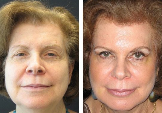 Patient-001a-non-surgical-facelift - Non-Surgical Facelift - Before And After | Fairfax and Manassas VA
