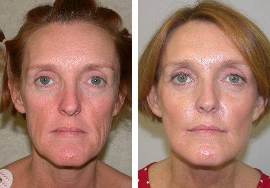 Patient-001a5270137c571c5-facelift - Facelift - Before And After Photos - Fairfax VA