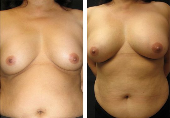 Patient-001a527026724c2a1-breast-implant-exchange - Breast Implant Exchange - Patient 9 - Before & After 1 | Fairfax and Manassas, VA
