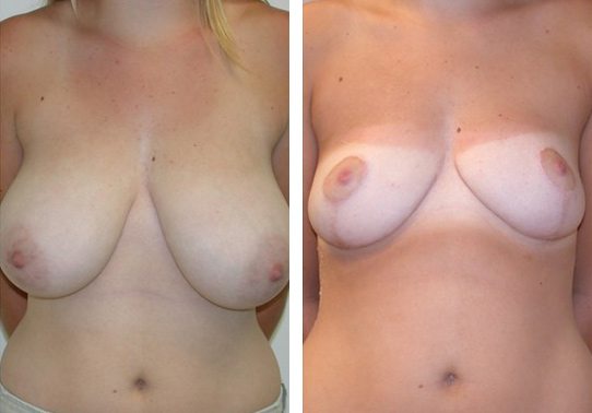 Patient-001a52702727deb30-breast-reduction - Breast Reduction Before And After - Fairfax and Manassas VA