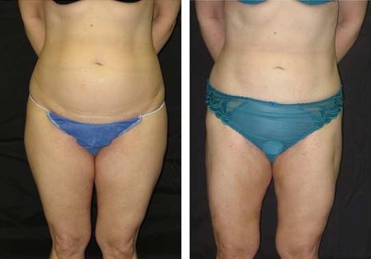 Patient-001a5271095c501ac-liposuction - Liposuction - Before And After - Fairfax and Manassas VA