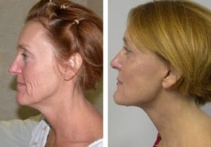 Patient-001b5270137cdbedb-facelift - Facelift - Before And After Photos - Fairfax VA