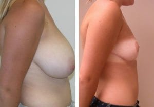 Patient-001b527027275405b-breast-reduction - Breast Reduction Before And After - Fairfax and Manassas VA