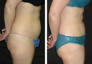 Patient-001b5271095cc6457-liposuction - Liposuction - Before And After - Fairfax and Manassas VA