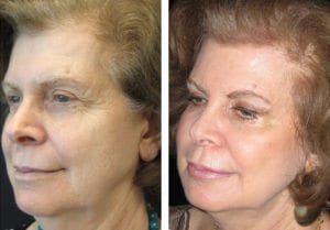 Patient-001c-non-surgical-facelift - Non-Surgical Facelift - Before And After | Fairfax and Manassas VA