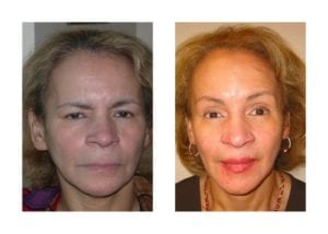 Forehead Lift Before And After - Fairfax and Manassas VA