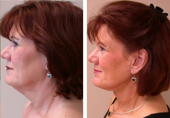 Patient-002527011b93b6ff-necklift - Neck Lift - Before And After | Fairfax and Manassas VA