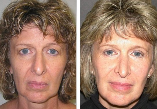 Patient-002527012bec1713-eyelid-lifts-upper - Upper Eyelid Lift - Before And After Photos - Fairfax and Manassas VA