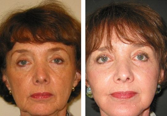 Patient-0025270131a52d96-eyelid-lifts-lower - Lower Eyelid Lift - Before And After - Fairfax and Manassas VA