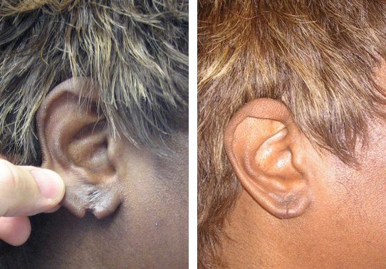 Patient-0025270149bf2532-torn-earlobe-repair - Torn Earlobe Repair - Before And After | Fairfax VA