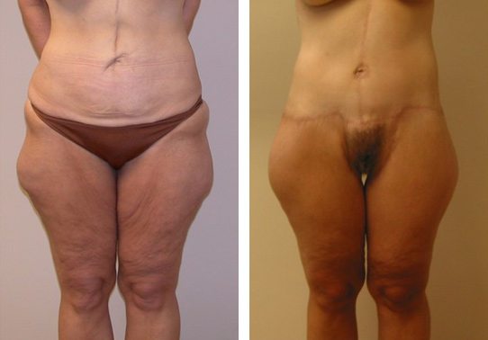Patient-00252710dcfc47d5-thigh-lifts - Thigh Lifts Before And After - Fairfax and Manassas VA