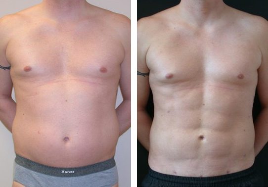 Abdominal Etching - Patient 6 - Before & After 1 | Fairfax and Manassas, VA - Abdominal Etching - Before And After - Fairfax and Manassas VA