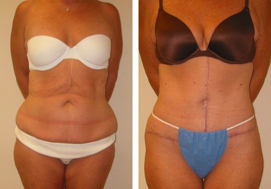 Patient-002a5271069817e58-tummy-tuck-abdominoplasty - Tummy Tuck - Before And After - Abdominoplasty - Fairfax VA