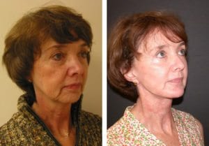 Patient-002b-facelift - Facelift - Before And After Photos - Fairfax VA