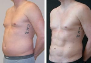 Abdominal Etching - Before And After - Fairfax and Manassas VA