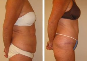 Patient-002b527106989cb6d-tummy-tuck-abdominoplasty - Tummy Tuck - Before And After - Abdominoplasty - Fairfax VA