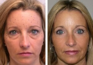 Lower Eyelid Lift - Before And After - Fairfax and Manassas VA