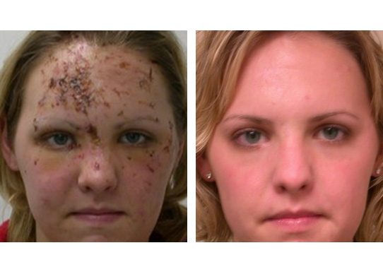 Patient-003527014d87e1fb-dermabrasion - Dermabrasion - Before And After - Fairfax and Manassas VA