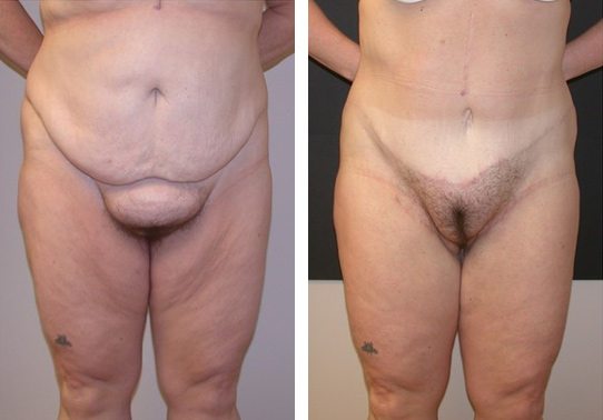 Patient-00352710dd321e03-thigh-lifts - Thigh Lifts Before And After - Fairfax and Manassas VA